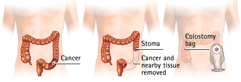 Colorectal cancer surgery and colostomy bag