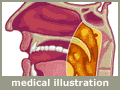 medical illustration - head and neck cancer